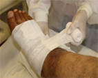 Treatment of difficult-to-heal venous ulcers with fibrin sealant
